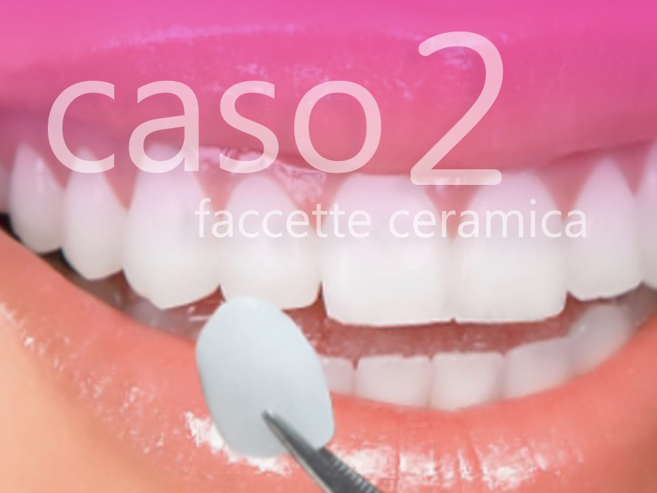 cover-facccette-ceramica-caso2