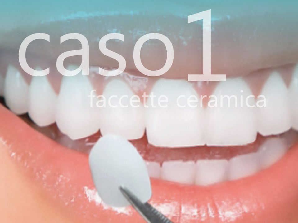 cover-facccette-ceramica-caso1