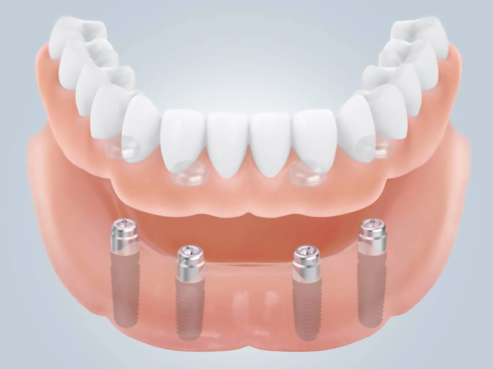 riabilitazione-mandibola-all-on-four