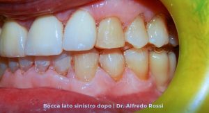 1_bocca-lato-sinistro-dopo_-dr.-alfredo-rossi
