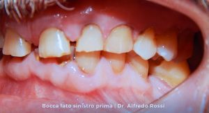 1_bocca-lato-sinistro-prima_-dr.-alfredo-rossi