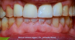 2_bocca-centro-dopo_-dr.-alfredo-rossi