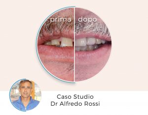 2_bocca-prima_dopo_-dr.-alfredo-rossi