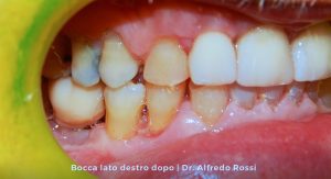 3_bocca-lato-destro-dopo_-dr.-alfredo-rossi