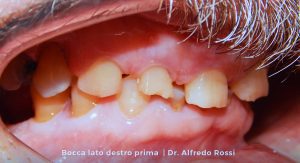 3_bocca-lato-destro-prima_-dr.-alfredo-rossi