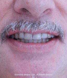 4_sorriso-dopo_-dr.-alfredo-rossi